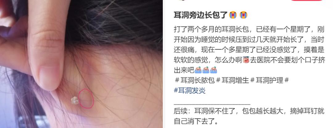 知名演员的妻子自述：年轻时打耳洞做了两次手术！坦言是&quo